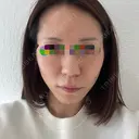 額を丸く / 脂肪注入（肌） / 脂肪注入（額） / 脂肪注入（輪郭） EMMA CLINIC（エマクリニック） BEFORE サムネイル用