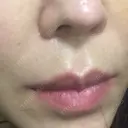 人中短縮 / 口唇縮小術 / 口角挙上 HB整形外科 BEFORE サムネイル用