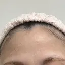 ピーリング（ニキビ・毛穴） 成城スカイファミリークリニック BEFORE サムネイル用