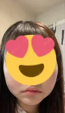 糸リフト / バッカルファット除去 / 脂肪吸引（顔） ブルームクリニック（BLOOM CLINIC） BEFORE サムネイル用