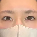 二重埋没 アリエル美容クリニック 郡山院 BEFORE サムネイル用
