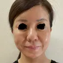 隆鼻術 / 軟骨移植 / 鼻尖縮小 エースクリニック 名古屋院 BEFORE サムネイル用