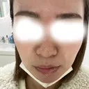 ピーリング（ハリ・ツヤ） アリエル美容クリニック 大宮院 BEFORE サムネイル用