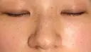 ピコスポット Olino美容外科・美容皮膚科 BEFORE サムネイル用