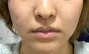 鼻翼基部形成（貴族手術） / ボトックス（あご） / ボトックス（口角） 大阪TAクリニック BEFORE サムネイル用