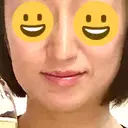 ボトックス（エラ・小顔） / 脂肪溶解注射（顔） / 脂肪溶解注射 渋谷美容外科クリニック 渋谷院 BEFORE サムネイル用