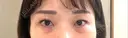 下まぶたの脂肪取り / 脂肪注入（目の下） セオリークリニック BEFORE サムネイル用