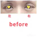 二重切開 / 眼瞼下垂（切開） / 上まぶたたるみ取り 心斎橋形成外科スキンケアクリニック BEFORE サムネイル用