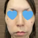 シミ取りレーザー / ピコレーザートーニング（美白・肝斑） フローラクリニック BEFORE サムネイル用