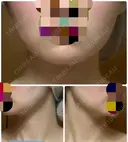 ボトックス（エラ・小顔） TCB東京中央美容外科 大宮東口院 BEFORE サムネイル用