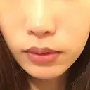 鼻翼基部形成（貴族手術） ジョウクリニック 大阪院 BEFORE サムネイル用