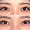ヒアルロン酸注入（涙袋） / ボトックス（タレ目） アネシス美容クリニック BEFORE サムネイル用