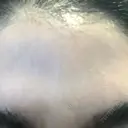 ダーマペン LIFIX BEAUTY CLINIC BEFORE サムネイル用