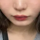 ヒアルロン酸注入（あご） アネシス美容クリニック BEFORE サムネイル用