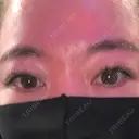 二重埋没 / 上まぶたの脂肪取り アリエル美容クリニック 郡山院 BEFORE サムネイル用