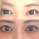 二重切開 ルネッサンス美容外科医院 神戸院 BEFORE サムネイル用