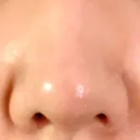 小鼻縮小（切開） GLANZ CLINIC BEFORE サムネイル用