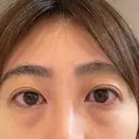 クマ治療 / 脂肪注入（目の下） / その他（目元） セオリークリニック BEFORE サムネイル用
