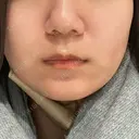 ポテンツァ レナータクリニック 立川院 BEFORE サムネイル用