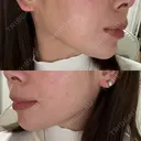 ボトックス（エラ・小顔） LE CLINIC BEFORE サムネイル用