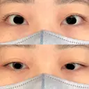 二重埋没 オーキッド美容クリニック東京御徒町 BEFORE サムネイル用