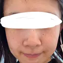毛穴洗浄（ハイドラフェイシャルなど） / 光治療（フォトフェイシャルなど） 代官山ウィメンズクリニック BEFORE サムネイル用