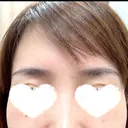 PRP皮膚再生療法 ももスキンケアクリニック BEFORE サムネイル用