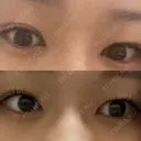 二重埋没 神戸中央クリニック美容外科 BEFORE サムネイル用