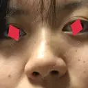 鼻尖形成（切開） / 鼻中隔延長（切開） / 小鼻縮小（切開） / 軟骨移植 / ワシ鼻修正・ハンプ切除 湘南メディカル記念病院（両国） BEFORE サムネイル用