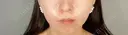 ボトックス（あご） / ヒアルロン酸注入（あご） ASTRA BEAUTY CLINIC BEFORE サムネイル用