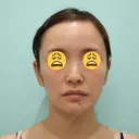 脂肪吸引（顔） / 輪郭修正 / ジョールファット除去 / 脂肪注入（輪郭） WOM CLINIC GINZA （ワム クリニック ギンザ） BEFORE サムネイル用