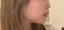 その他（輪郭） / ヒアルロン酸注入（あご） ASTRA BEAUTY CLINIC BEFORE サムネイル用