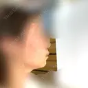 ボトックス（あご） / ヒアルロン酸注入（あご） / ボトックス（口角） / ボトックス（人中） / その他（口元） 表参道スキンクリニック 名古屋院（DAILY SKIN CLINIC提携院） BEFORE サムネイル用