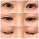 二重埋没 / 目頭切開 くさのたろうクリニック BEFORE サムネイル用