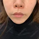 ヒアルロン酸注入（唇） / ボトックス（口角） ルラ美容クリニック 高田馬場院 BEFORE サムネイル用