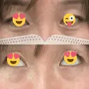 クマ治療 / 下まぶたの脂肪取り / ヒアルロン酸注入（目の下） / ボトックス（眉間） / ボトックス（目尻） / その他（鼻） YBC横浜美容外科 大宮院 BEFORE サムネイル用