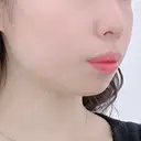 ヒアルロン酸注入（あご） ASTRA BEAUTY CLINIC BEFORE サムネイル用