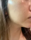 ピコレーザートーニング（美白・肝斑） / ピコフラクショナルレーザー（毛穴・ニキビ跡） ルラ美容クリニック 渋谷本院 BEFORE サムネイル用