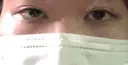 眼瞼下垂（切開） 十仁美容整形 BEFORE サムネイル用