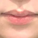ヒアルロン酸注入（唇） 心斎橋形成外科スキンケアクリニック BEFORE サムネイル用