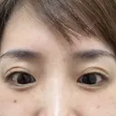 PRP皮膚再生療法 / その他（目元） ももスキンケアクリニック BEFORE サムネイル用