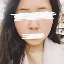 鼻尖形成（切開） / 鼻中隔延長（切開） / 小鼻縮小（切開） / 軟骨移植 / 鼻尖縮小 HANABI整形外科 BEFORE サムネイル用