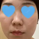 ピーリング（ハリ・ツヤ） まゆりなclinic 名古屋栄 BEFORE サムネイル用
