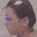 バッカルファット除去 / 脂肪吸引（顔） / ヒアルロン酸注入（鼻） / ボトックス（あご） / 水光注射（ハリ・美肌） / ボトックス（エラ・小顔） / ボトックス（口角） / 白玉点滴・注射 エートップ美容整形外科 BEFORE サムネイル用