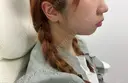 ヒアルロン酸注入（あご） / ボトックス（エラ・小顔） ASTRA BEAUTY CLINIC BEFORE サムネイル用