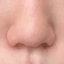 鼻孔縁挙上 GLANZ CLINIC BEFORE サムネイル用