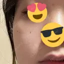 ほくろ・いぼ除去レーザー（肌） 心斎橋形成外科スキンケアクリニック BEFORE サムネイル用