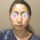 アートメイク（眉） TRUE DESIGN CLINIC BEFORE サムネイル用