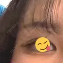 ヒアルロン酸注入（涙袋） / ボトックス（タレ目） アネシス美容クリニック BEFORE サムネイル用