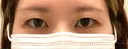 二重埋没 Olino美容外科・美容皮膚科 BEFORE サムネイル用